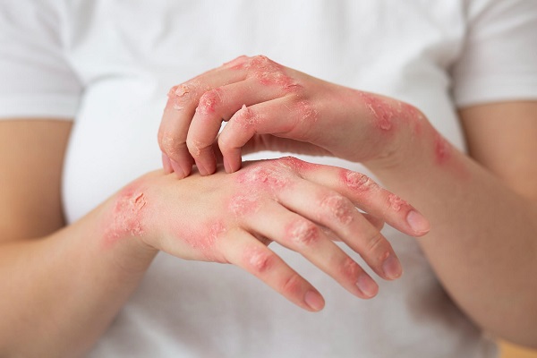 Ayurvedic Treatment For Syphilis In Aizawl